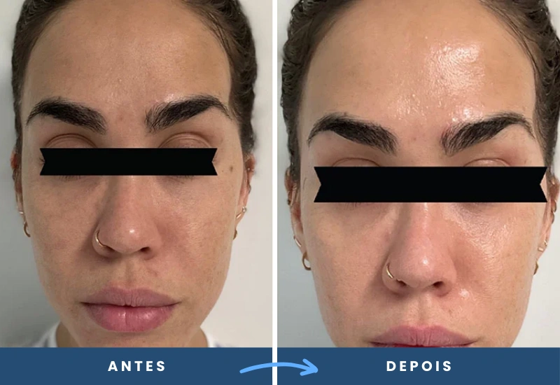microagulhamento cicatrizes de acne cuidados