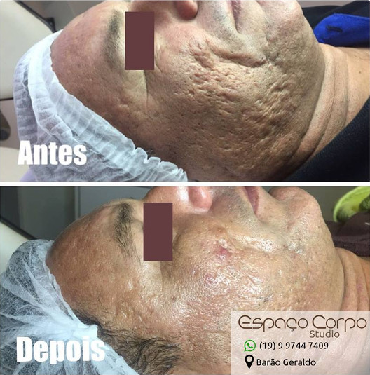 microagulhamento rejuvenescimento cuidados