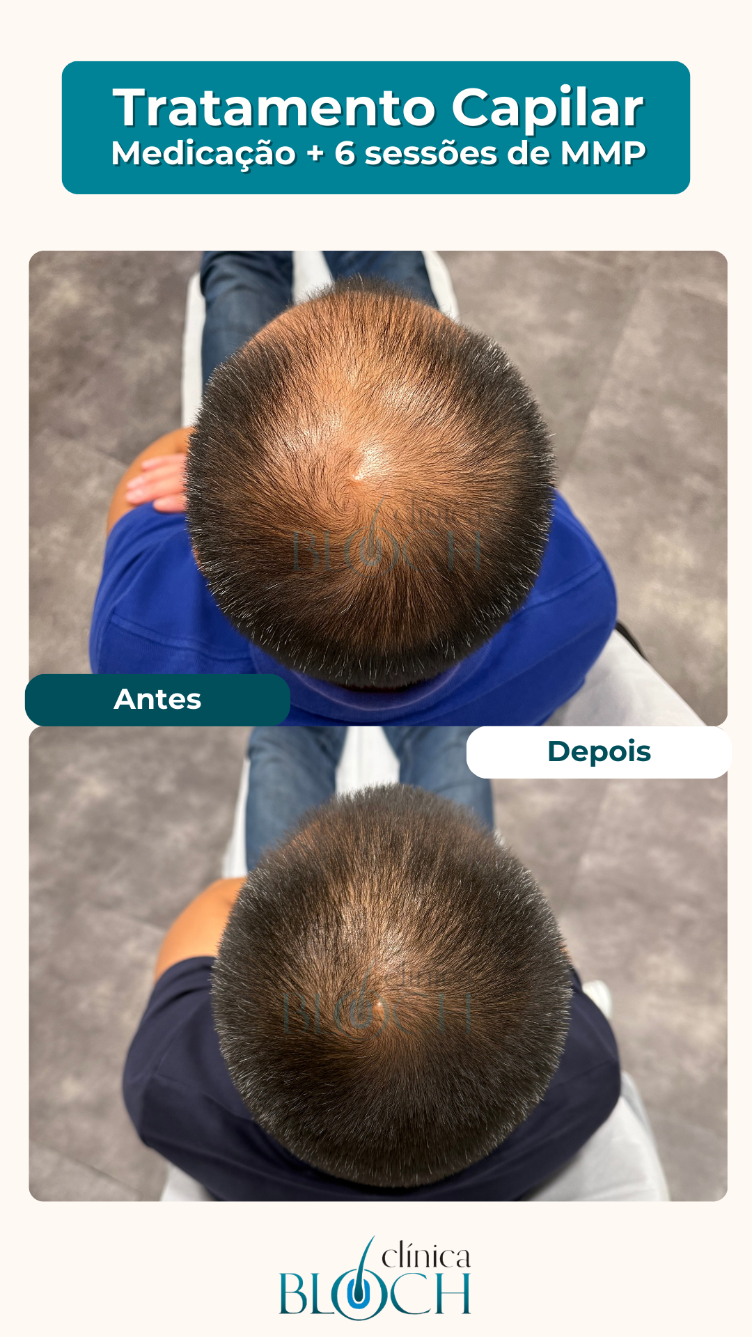 5 ideias de títulos:
1. Microenxerto Capilar vs. Transplante Capilar: Qual a Melhor Opção para Você?
2. Regenera Activa: Tudo Sobre a Terapia Celular para Queda de Cabelo
3. Quanto Custa Tratar a Calvície? Comparativo de Procedimentos Capilares no Brasil
4. Fatores que Influenciam o Preço do Microenxerto Capilar
5. A Ciência por Trás do Microenxerto Autólogo: Reativando Seus Fios