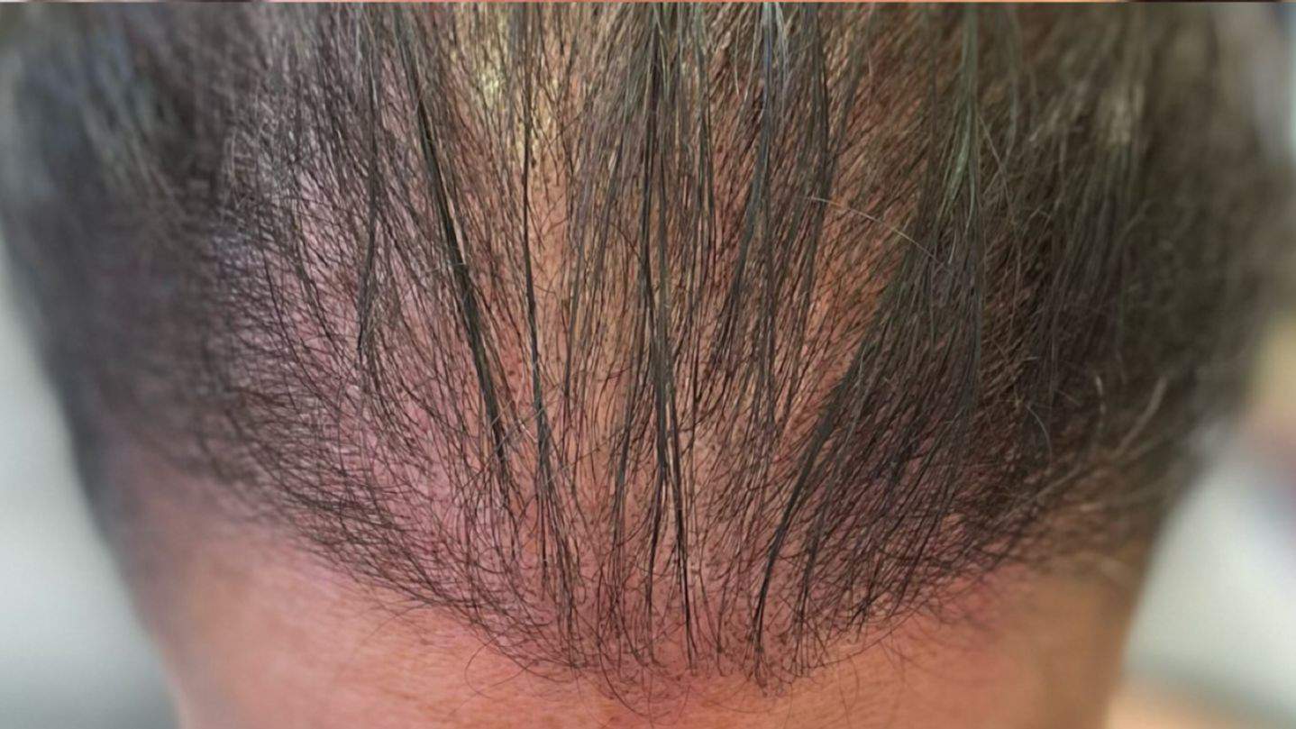 Microenxerto autólogo capilar preço