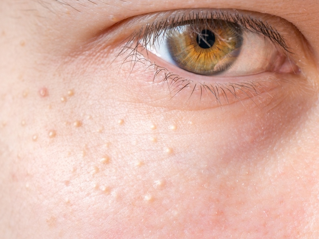 milium no rosto como tratar