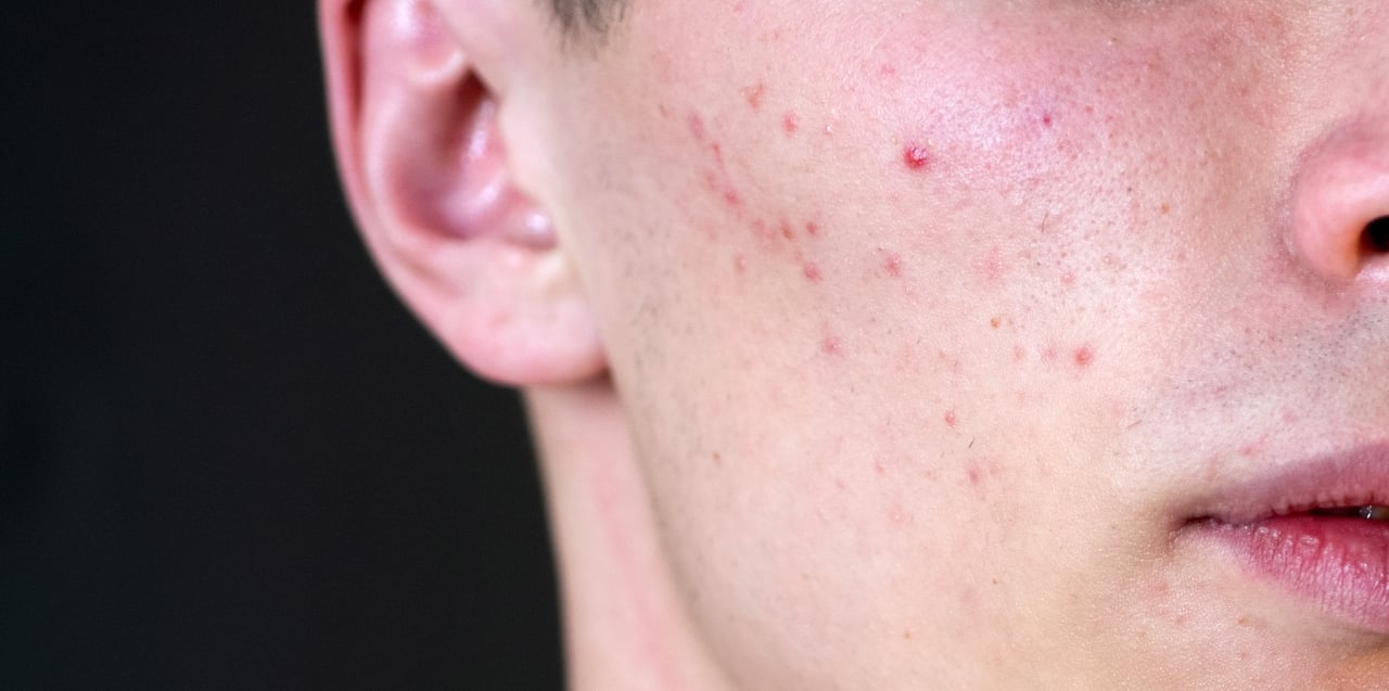 melhores tratamentos para milium no rosto