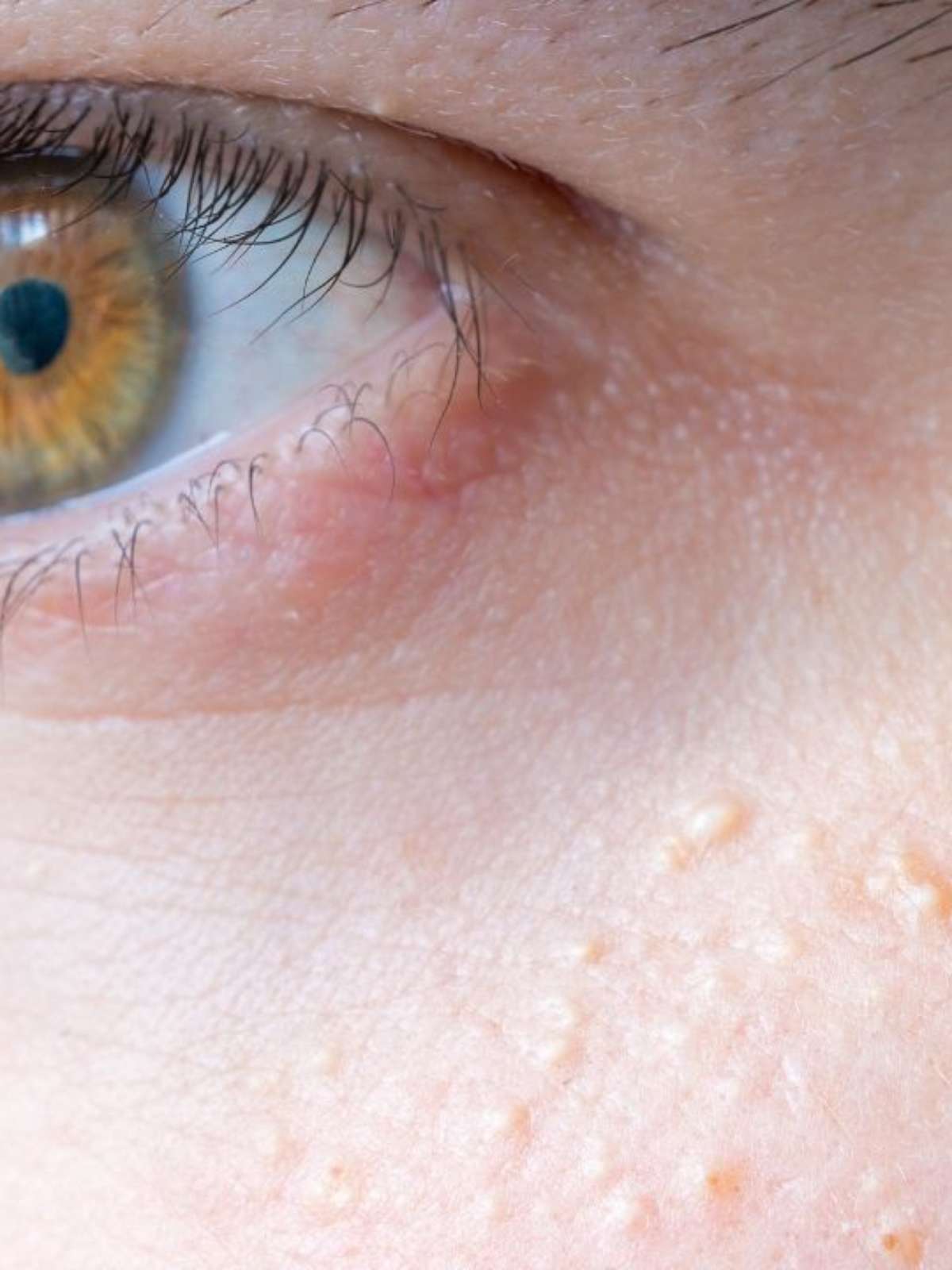 erros comuns ao tratar milium em casa