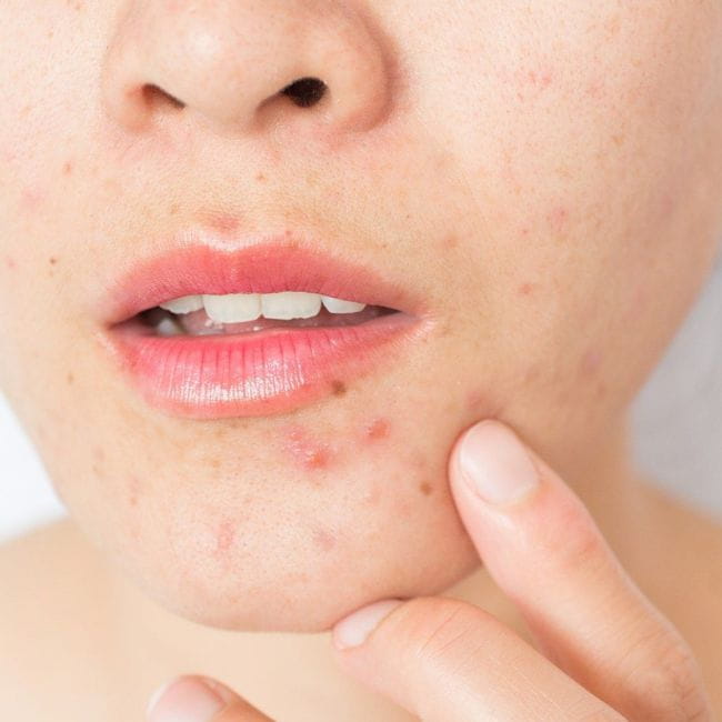 Desvendando a Rosácea e Dermatite: Causas