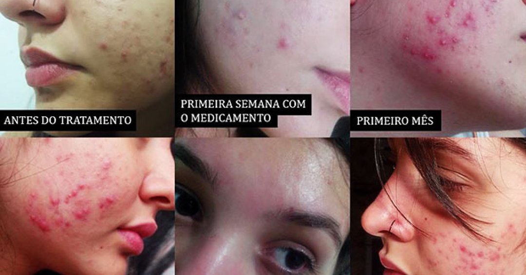 Os Melhores Ingredientes para Hidratar a Pele Oleosa sem Efeito Rebote