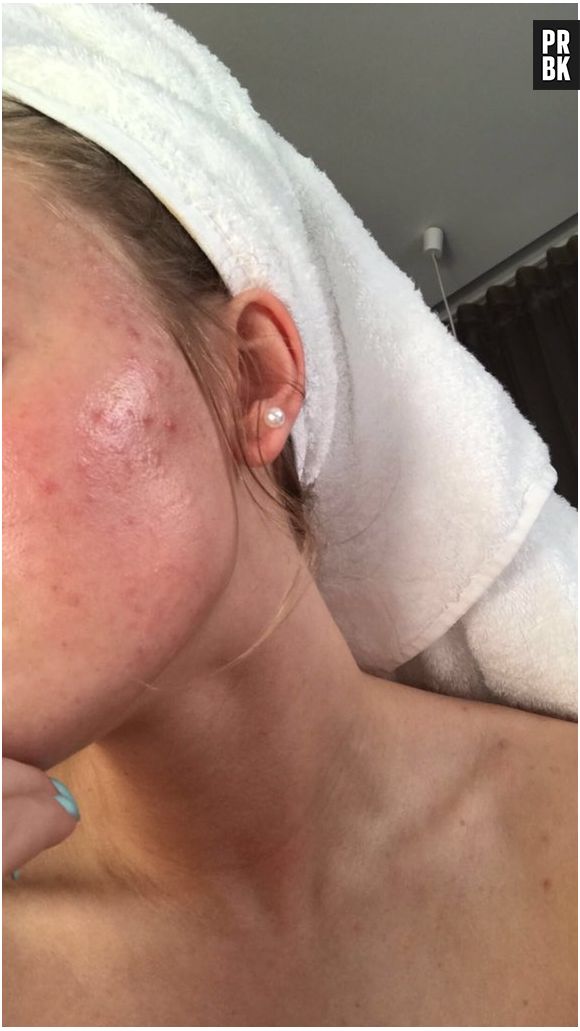 Os Melhores Ingredientes para Hidratar a Pele Oleosa sem Efeito Rebote