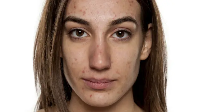 Sintomas e Tratamentos