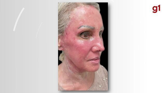 Os Melhores Ingredientes para Hidratar a Pele Oleosa sem Efeito Rebote