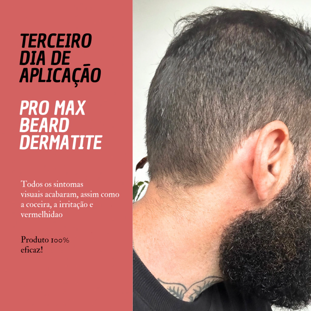 Dermatite Seborreica e Minoxidil: Dicas para Controlar a Caspa e a Irritação