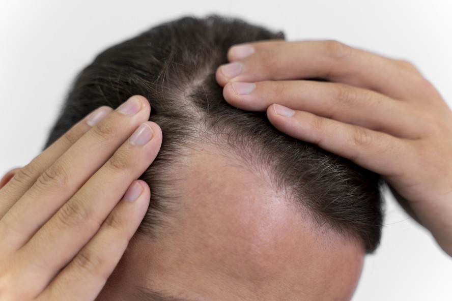 Fórmulas Manipuladas de Minoxidil: Personalize seu Tratamento contra a Coceira