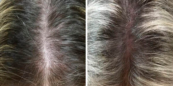 MMP capilar para queda de cabelo feminina