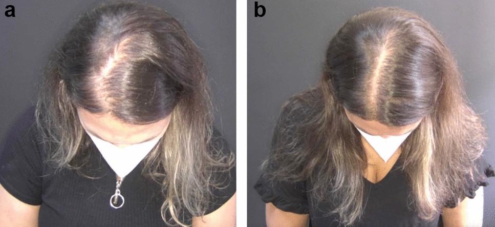 MMP Capilar: O que é e como funciona?