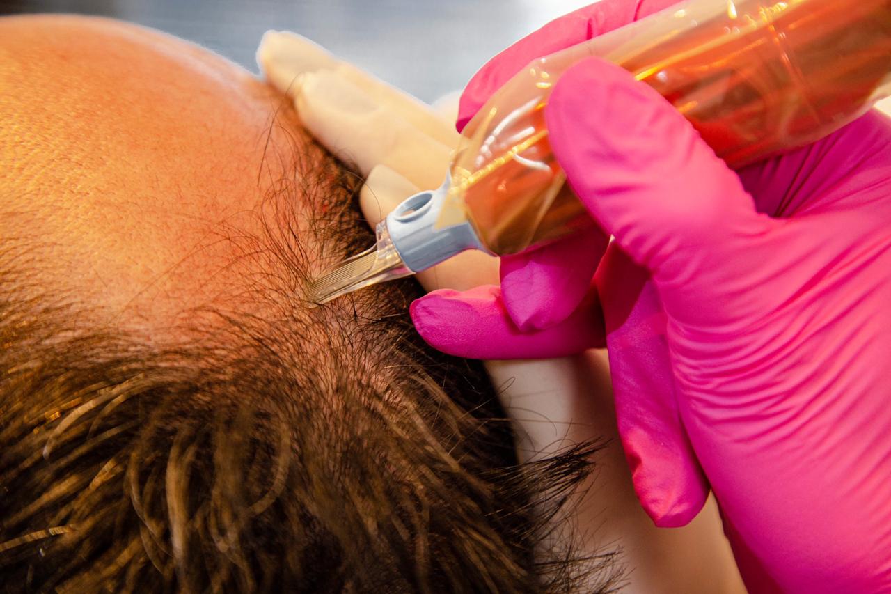 MMP Capilar vs. outros tratamentos para queda de cabelo