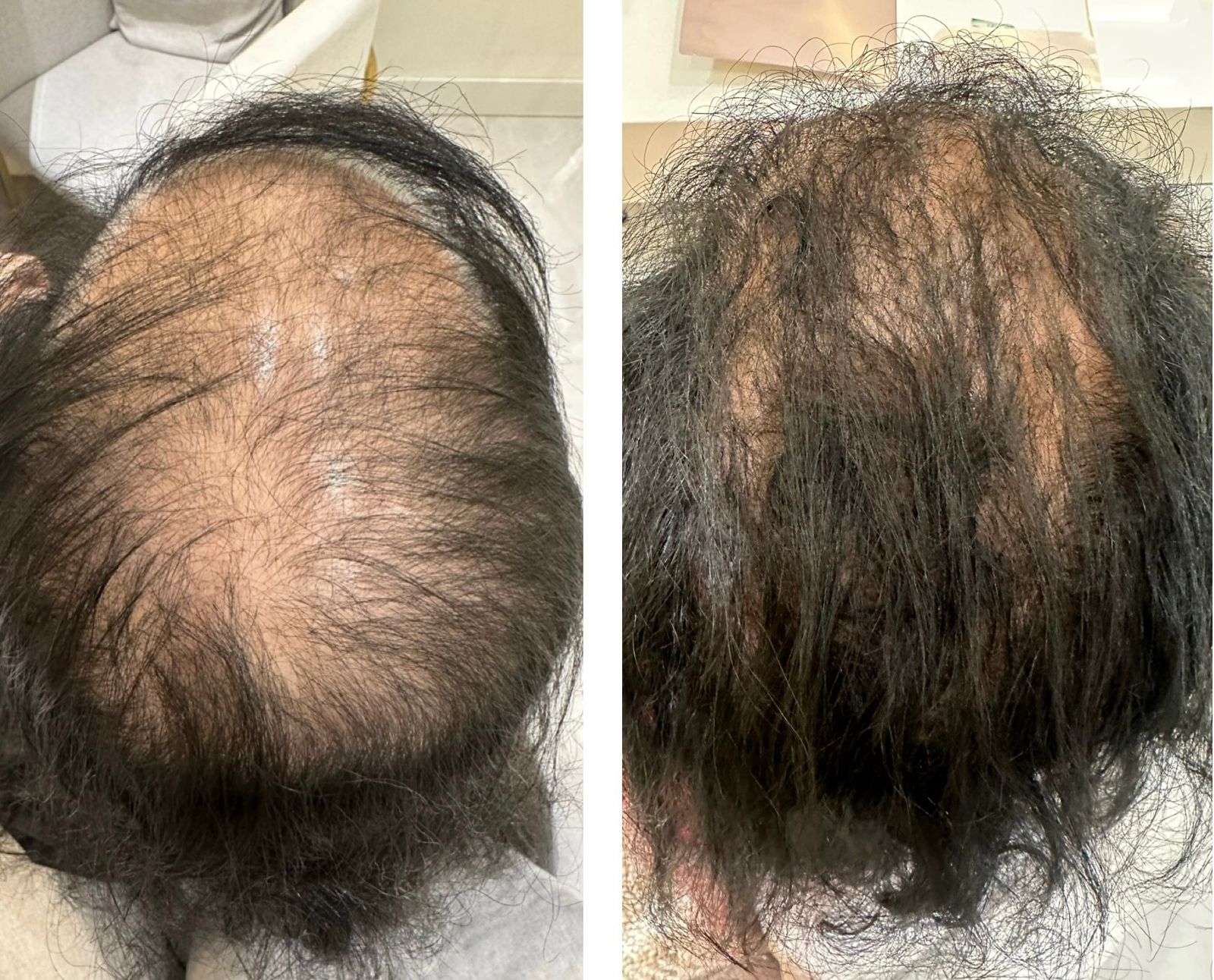 Benefícios e resultados do MMP Capilar