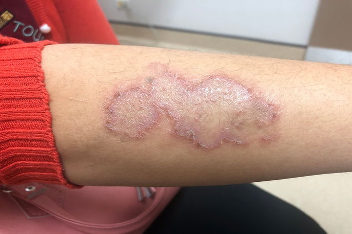 como a umidade causa micose na pele