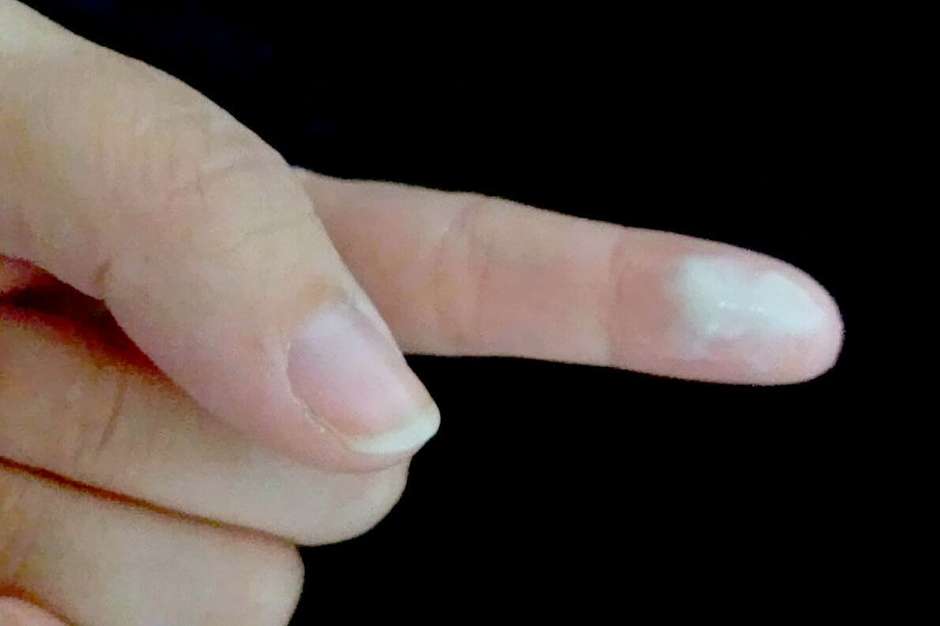 erros comuns ao lidar com corrimento branco