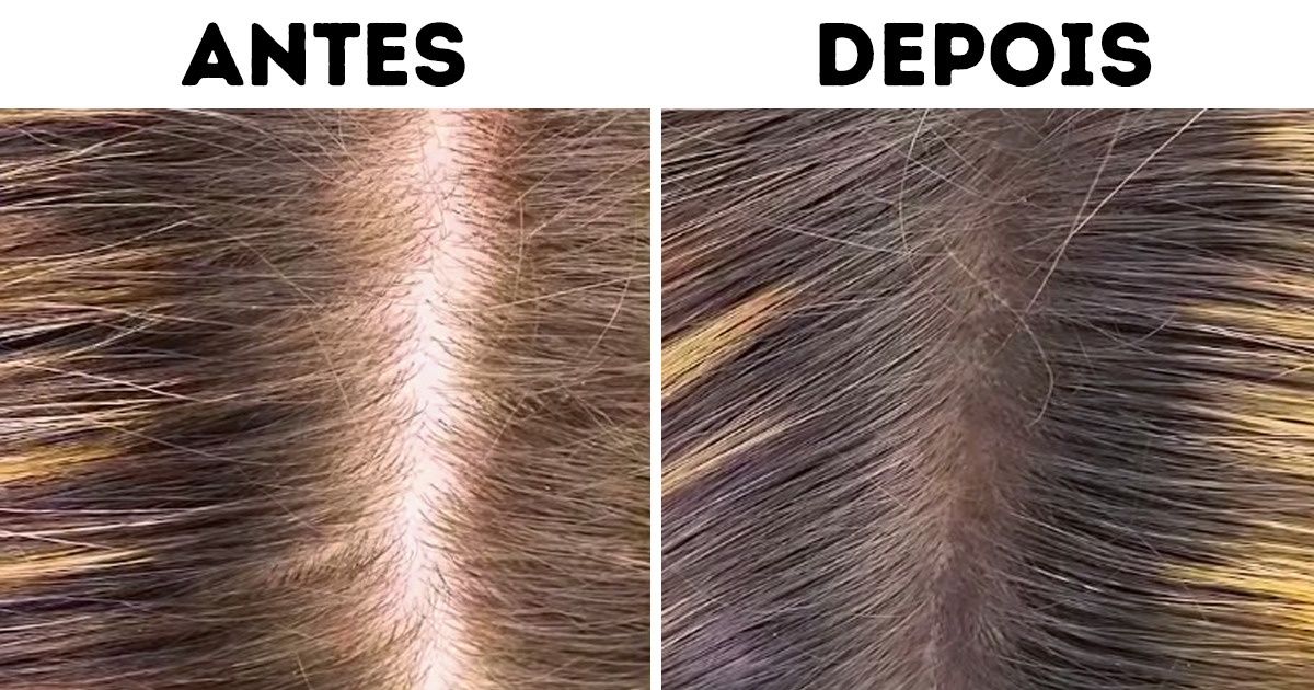 Queda de Cabelo: Quando o Óleo de Coco Pode Ajudar e Quando Evitar