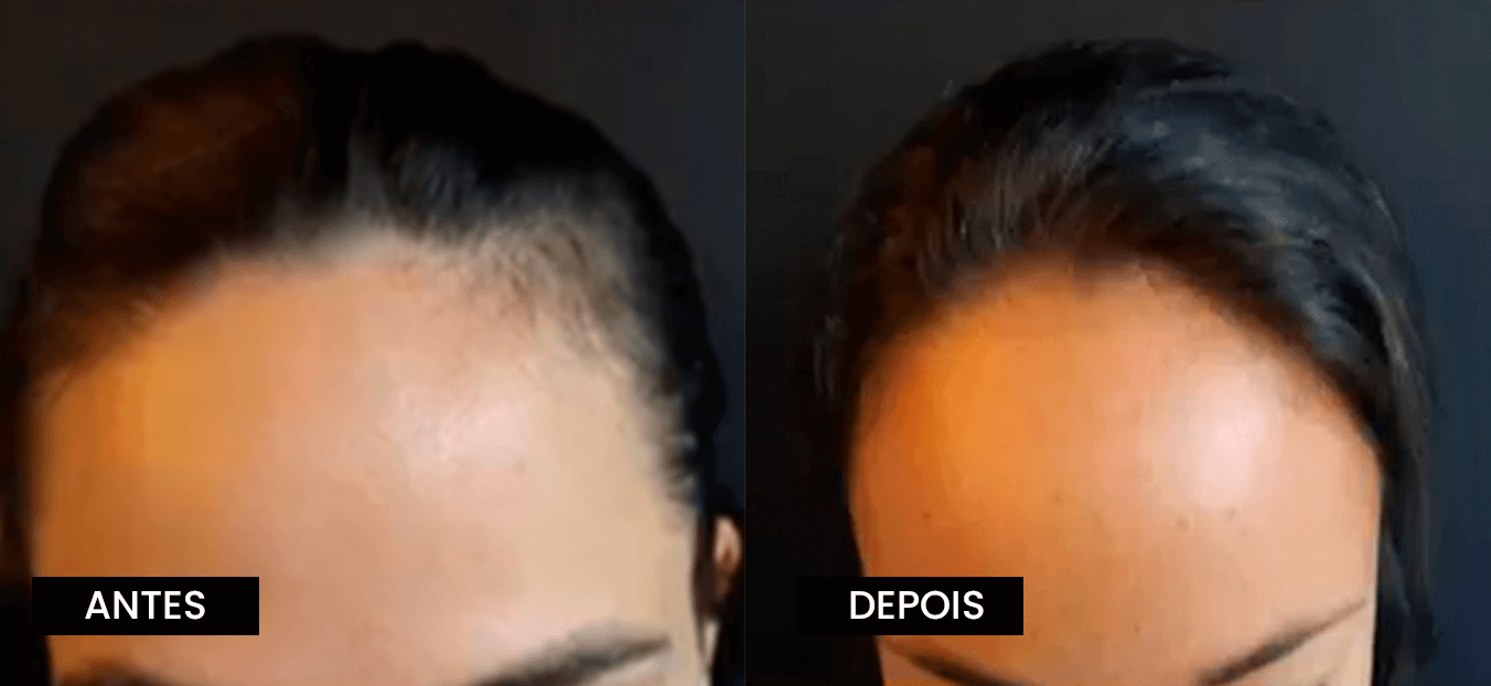 1. Transplante Capilar Feminino: Guia Completo em Goiânia
2. As Melhores Clínicas para Transplante Capilar Feminino em Goiânia
3. Fatores que Influenciam o Preço do Transplante Capilar Feminino
4. Técnicas de Transplante Capilar: FUE vs. FUT para Mulheres
5. Recuperação Pós-Transplante Capilar Feminino: O Que Esperar