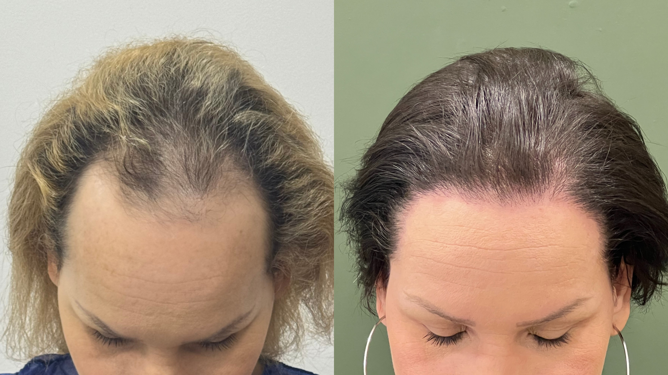 Orçamento transplante capilar feminino Goiânia