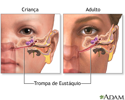 Otite Em Bebe De 1 Ano