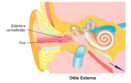 Otite Em Bebe De 1 Ano