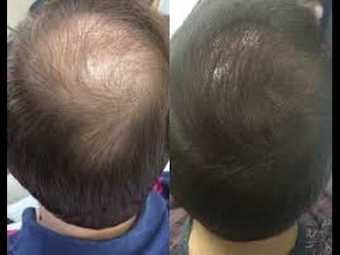 Plasma Rico em Plaquetas capilar valor Brasil