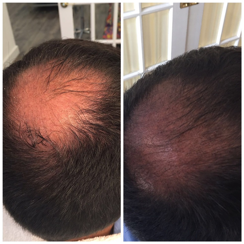 MMP Capilar: Uma Alternativa Segura ao PRP para Queda de Cabelo