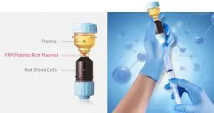 PRP Capilar no Brasil: Entenda a Situação Legal e Riscos