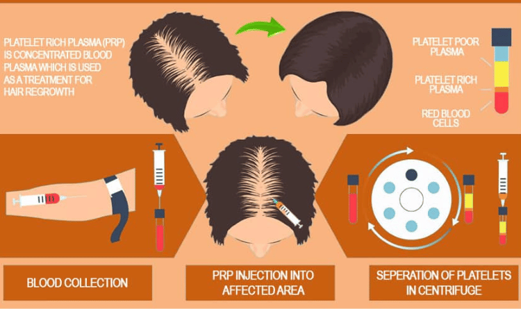 Plasma Rico em Plaquetas capilar valor Brasil