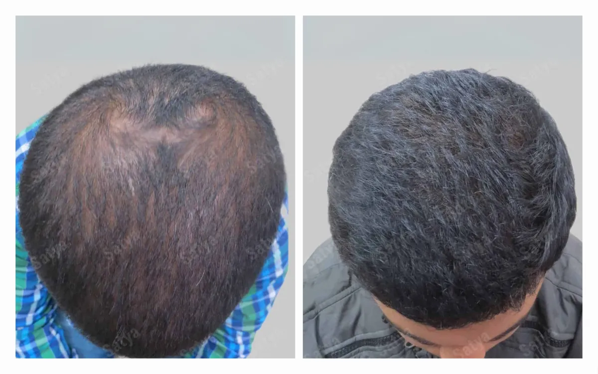 PRP Capilar no Brasil: Entenda a Situação Legal e Riscos