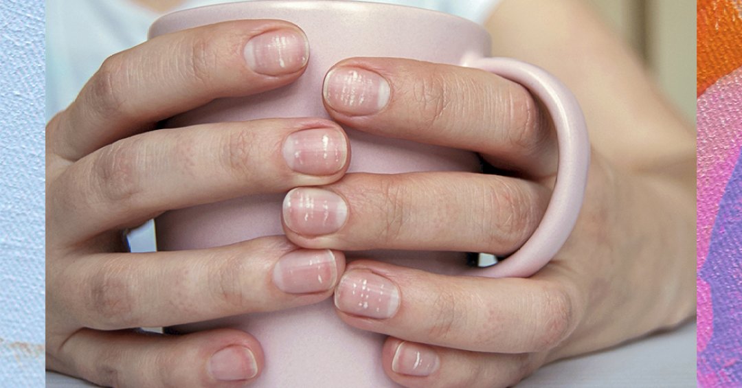 7 dicas para evitar manchas brancas nas unhas