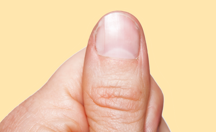 por que minhas unhas estão com manchas brancas