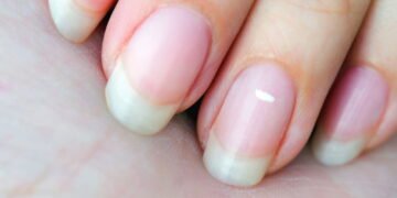7 dicas para evitar manchas brancas nas unhas