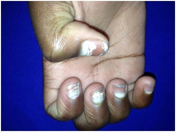 erros comuns que causam manchas brancas nas unhas