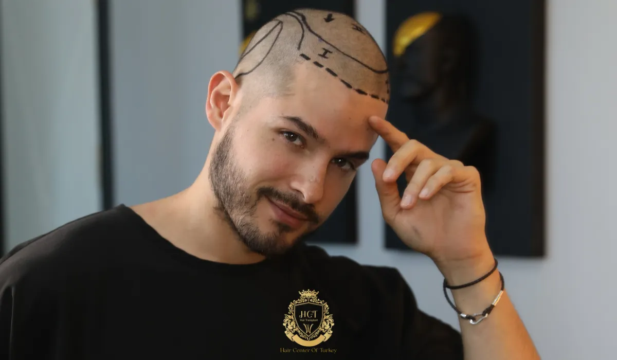 Guia Completo de Preços para Transplante Capilar em 2026