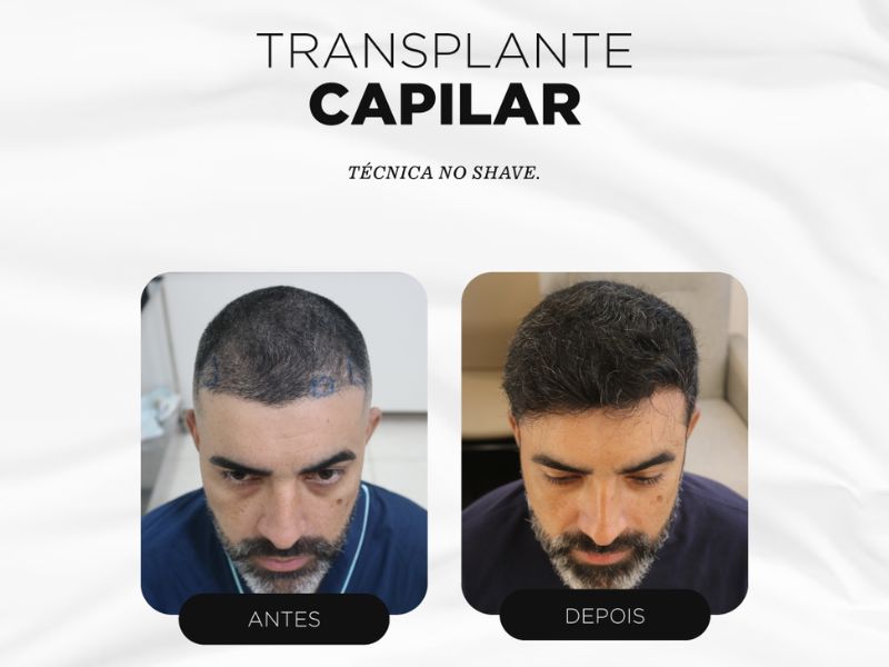 Fatores que Influenciam o Custo do Transplante Capilar Internacional