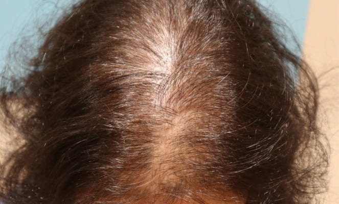 Primeiros sinais de alopecia feminina o que fazer