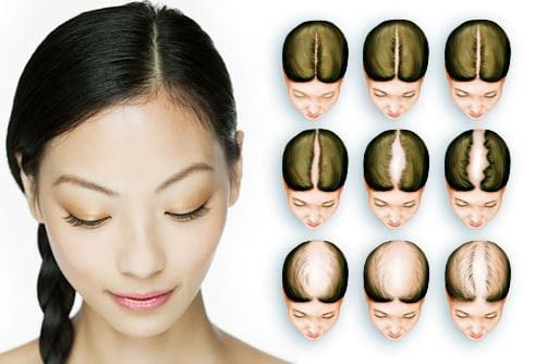 Alopecia Feminina: Guia Completo de Sinais