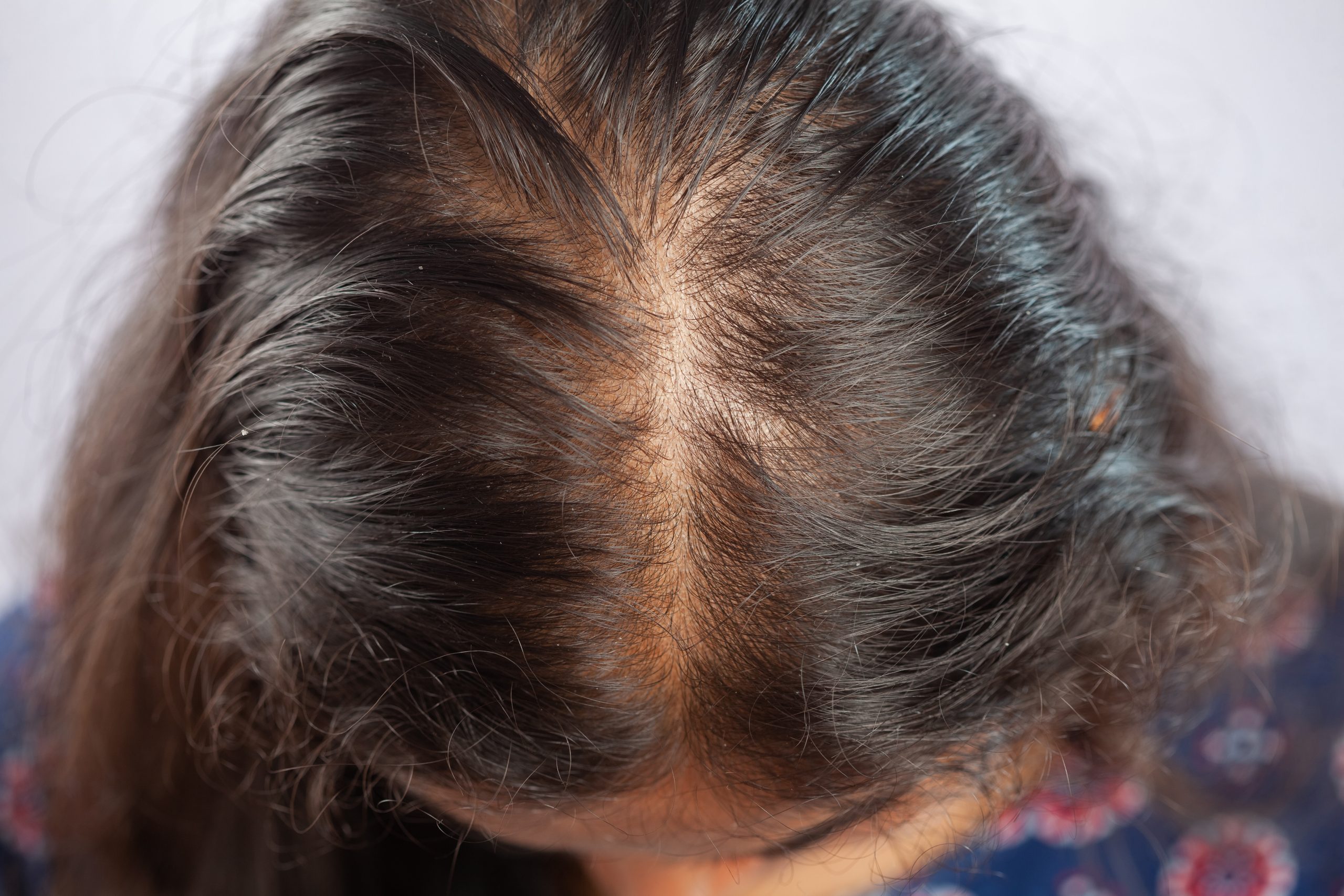 Primeiros sinais de alopecia feminina o que fazer