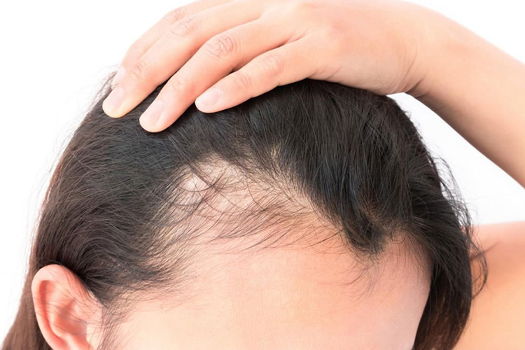 Alopecia Feminina: Guia Completo de Sinais