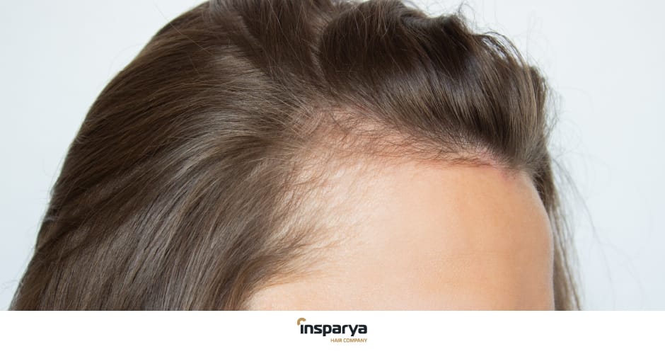 Causas e Tratamentos; Queda de Cabelo em Mulheres: Quando Procurar um Especialista?; Tricoscopia e Outros Exames Essenciais para Alopecia Feminina; Minoxidil e Alopecia Feminina: Mitos e Verdades sobre o Tratamento; Dieta e Hormônios: A Relação com a Queda de Cabelo em Mulheres