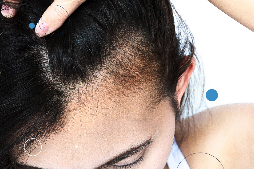 Primeiros sinais de alopecia feminina o que fazer