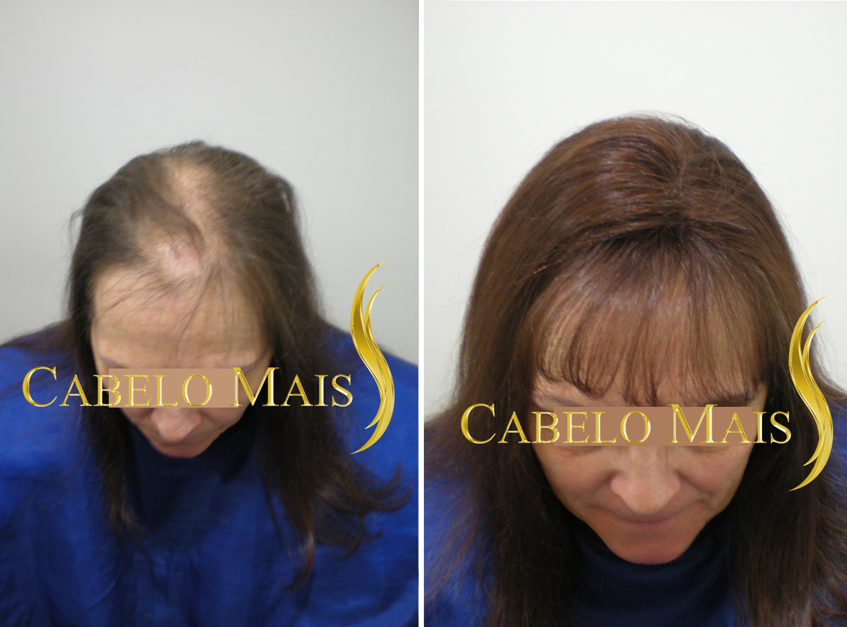 Avaliação Gratuita de Prótese Capilar Feminina em São Paulo: O Que Esperar