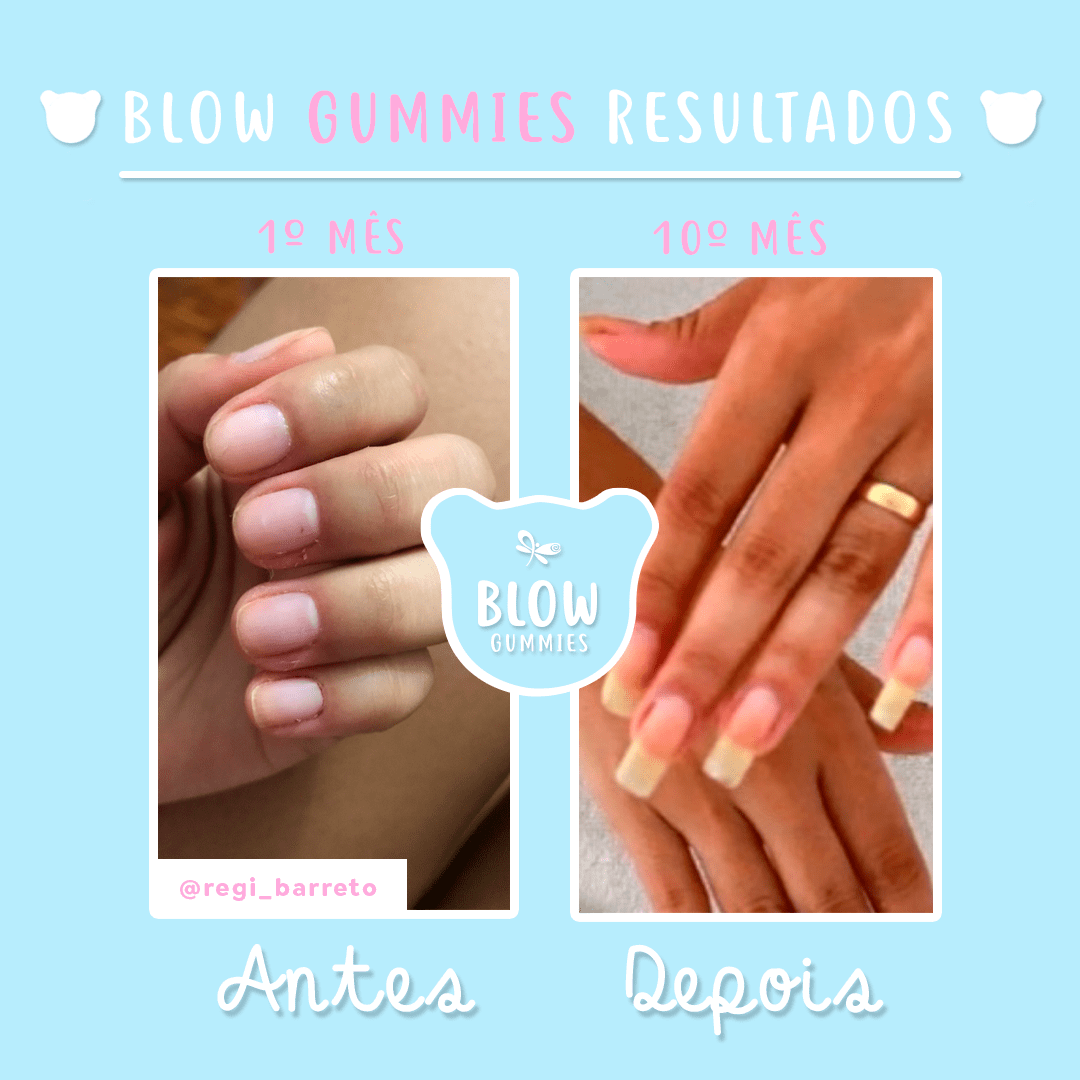 5 ideias de títulos:
1. Guia Completo: Vitaminas e Minerais Essenciais para Unhas Fortes
2. Unhas Quebradiças? Descubra os Nutrientes que Podem Salvar Suas Unhas
3. A Relação Entre Dieta e Unhas Saudáveis: O Que Você Precisa Saber
4. Fortalecendo Suas Unhas de Dentro para Fora: Um Olhar Sobre a Nutrição
5. Sinais de Alerta: Quando Unhas Fracas Indicam Problemas de Saúde