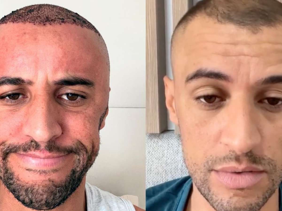 Realidade aumentada no transplante capilar