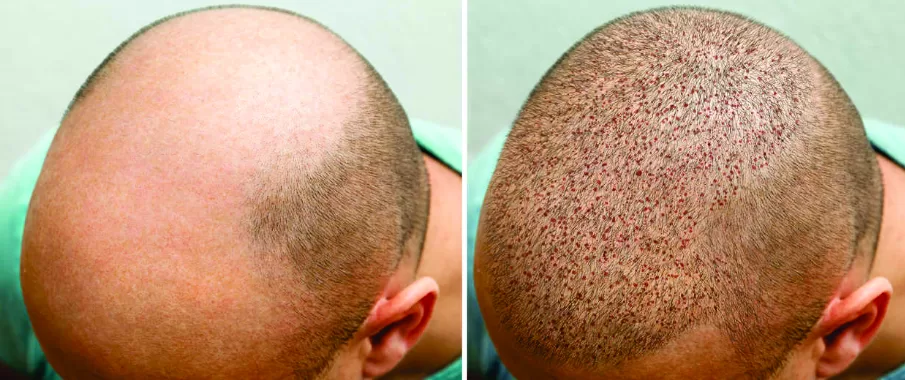 Realidade aumentada no transplante capilar