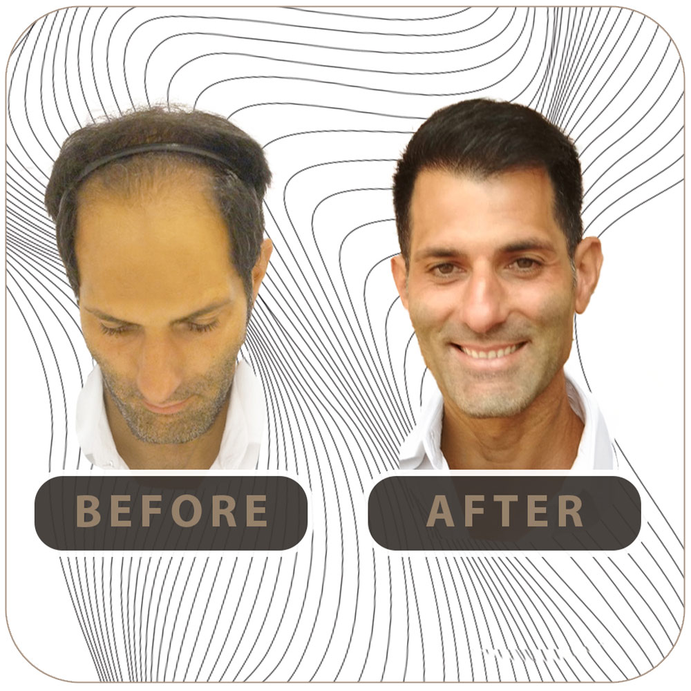 Realidade aumentada no transplante capilar