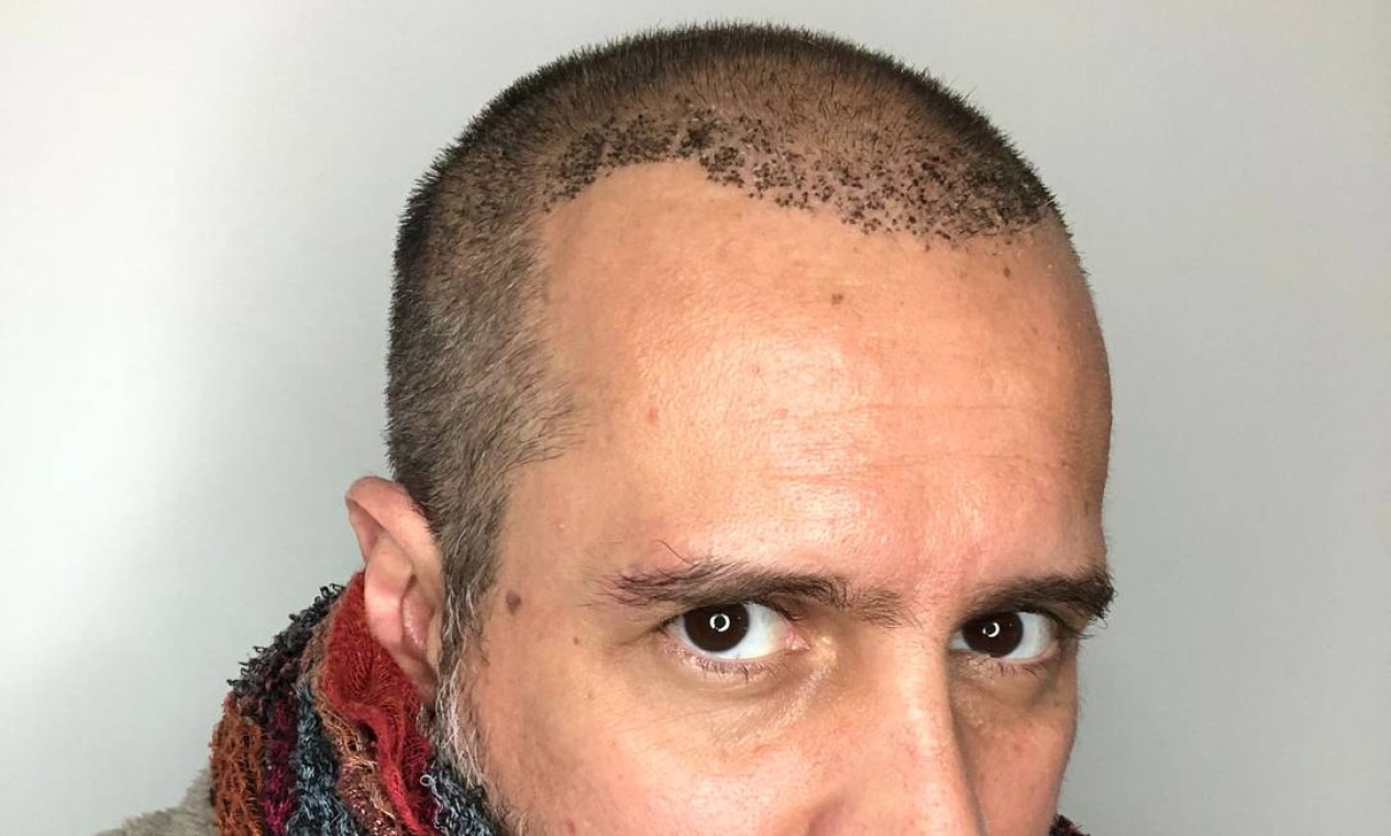 5 ideias de títulos:
1. Realidade Aumentada no Transplante Capilar: O Futuro Já Chegou!
2. Como a RA Está Revolucionando o Planejamento de Transplantes Capilares
3. Veja Seu Novo Cabelo Antes da Cirurgia: O Poder da RA
4. Precisão Cirúrgica Aumentada: A RA na Implantação Capilar
5. Benefícios Inovadores da Realidade Aumentada para o Transplante Capilar