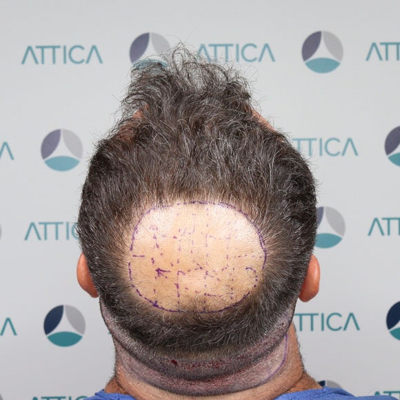 Realidade aumentada no transplante capilar