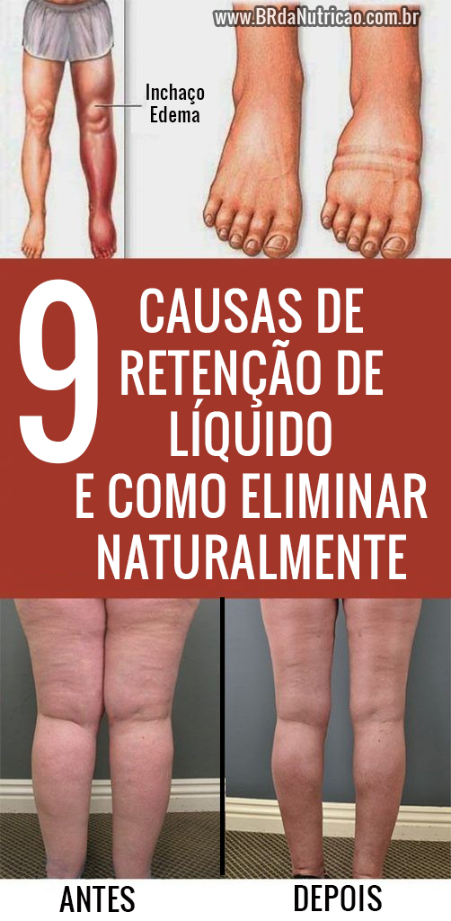o que causa retenção de líquido nas pernas